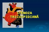 stenoza tricuspidiana