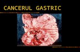 CANCERUL GASTRIC. CANCERUL GASTRIC - Epidemiologie Prevalenţa variază mult în funcţie de zona geografică, în funcţie de obiceiurile alimentare Foarte.