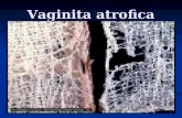 Vaginita atrofica