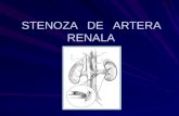 Stenoza de Artera Renala