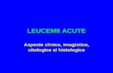 3. Leucemiile Acute