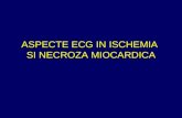 16174037 Aspecte ECG in Ischemia Si Necroza Miocardica