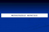 metastaze hepatice