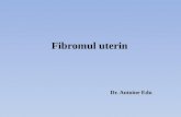 30. Fibromul uterin.final.pptx