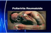 C3. Poliartrita Reumatoida.ppt