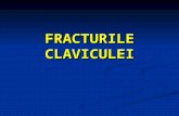 FRACTURILE CLAVICULEI