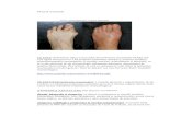 Piciorul reumatoid