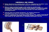 Hernia de Disc Veche