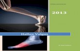 Hallux Valgus - Chirurg Ortoped · 2013-02-11 · (bursectomie) si remodelarea capului metatarsian 1 (emondaj) Forma moderata Montul creste in dimensiuni, este dureros atat in timpul